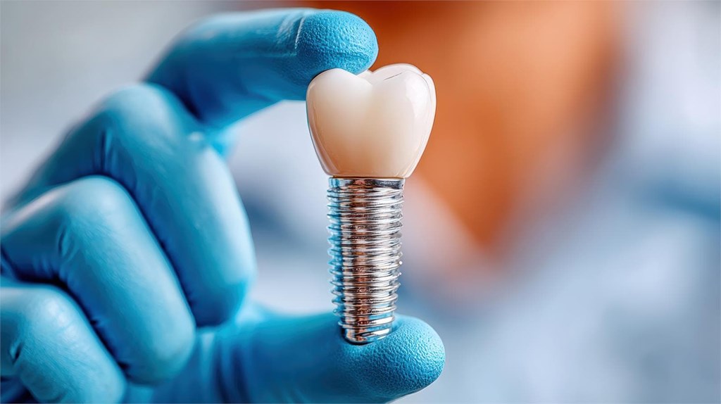 3 cuidados y mantenimiento de tus nuevos implantes dentales