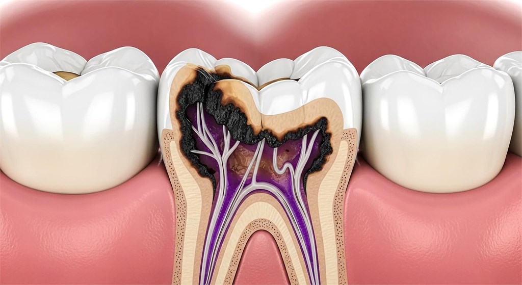 ¿Cómo prevenir las caries? 3 Consejos infalibles para adultos y niños