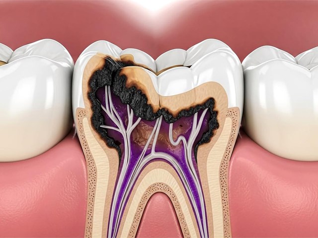¿Cómo prevenir las caries? 3 Consejos infalibles para adultos y niños