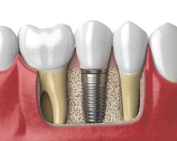 Implantología en Oroso